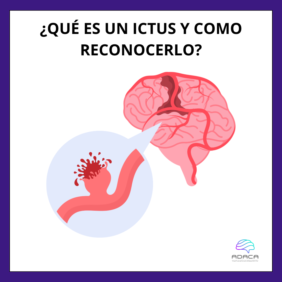 Imagen del ictus hemorrágico